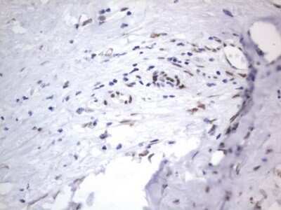 Immunohistochemistry: A2BP1 Antibody (OTI4F9) - Azide and BSA Free [NBP2-71965] - Analysis of Carcinoma of Human liver tissue .(Heat-induced epitope retrieval by 1 mM EDTA in 10mM Tris, pH8.5, 120C for 3min)