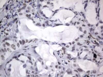 Immunohistochemistry: A2BP1 Antibody (OTI4F9) - Azide and BSA Free [NBP2-71965] - Analysis of Carcinoma of Human lung tissue.(Heat-induced epitope retrieval by 1 mM EDTA in 10mM Tris, pH8.5, 120C for 3min)