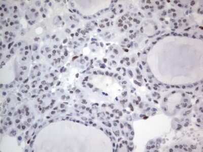 Immunohistochemistry: A2BP1 Antibody (OTI4F9) - Azide and BSA Free [NBP2-71965] - Analysis of Carcinoma of Human thyroid tissue. (Heat-induced epitope retrieval by 1 mM EDTA in 10mM Tris, pH8.5, 120C for 3min)