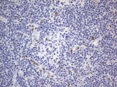 Immunohistochemistry: A2BP1 Antibody (OTI4F9) - Azide and BSA Free [NBP2-71965] - Analysis of Human lymphoma tissue. (Heat-induced epitope retrieval by 1 mM EDTA in 10mM Tris, pH8.5, 120C for 3min)