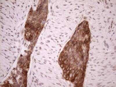 Immunohistochemistry: AAAS Antibody (OTI5B10) - Azide and BSA Free [NBP2-71358] - Analysis of Adenocarcinoma of Human endometrium tissue. (Heat-induced epitope retrieval by 1mM EDTA in 10mM Tris buffer (pH8.5) at 120C for 3 min)