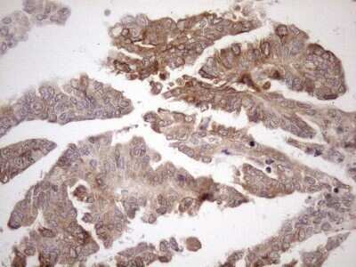 Immunohistochemistry: AAAS Antibody (OTI5B10) - Azide and BSA Free [NBP2-71358] - Analysis of Adenocarcinoma of Human ovary tissue. (Heat-induced epitope retrieval by 1mM EDTA in 10mM Tris buffer (pH8.5) at 120C for 3 min)