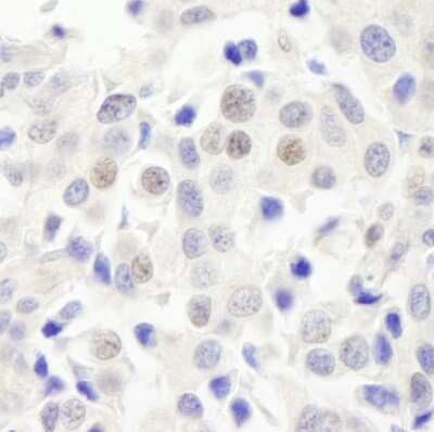 Immunohistochemistry: ABC2 Antibody [NB100-74598] - Sample: FFPE section of human breast carcinoma. Antibody: Affinity purified rabbit anti-ABC2 used at a dilution of 1:1,000 (1ug/ml). Detection: DAB staining using Immunohistochemistry Accessory Kit.