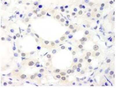 Immunohistochemistry-Paraffin: ABC2 Antibody [NB100-74598] - FFPE section of human thyroid carcinoma. Antibody: Affinity purified rabbit anti-ABC2 used at  a dilution of 1:250. Detection: DAB staining using  Immunohistochemistry Accessory Kit