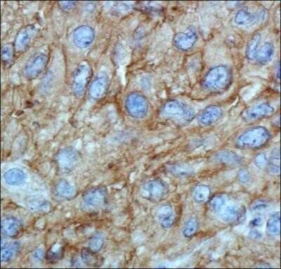 Immunohistochemistry: ABCA1 Antibody (HJ1) - Azide and BSA Free [NBP2-80554] - Analysis of ABCA1 in human renal cancer using DAB with hematoxylin counterstain. Image from the standard format of this antibody.