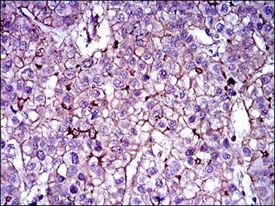 Immunohistochemistry-Paraffin: ABCB5 Antibody (5H3C6) [NBP2-22213] - Analysis of paraffin-embedded liver cancer tissues using ABCB5 mouse mAb with DAB staining.