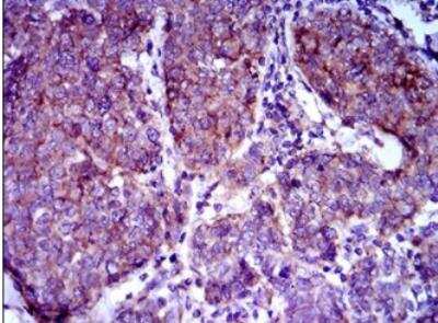 Immunohistochemistry-Paraffin: ABCB5 Antibody (5H3C6) [NBP2-22213] -  Analysis of paraffin-embedded breast cancer tissues using ABCB5 mouse mAb with DAB staining.