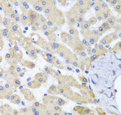 Immunohistochemistry-Paraffin: ABCB8 Antibody [NBP2-92883] - Human liver damage using ABCB8 antibody at dilution of 1:100 (40x lens).