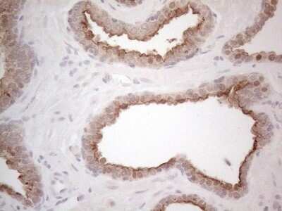 Immunohistochemistry: ABCC5 Antibody (OTI2C8) - Azide and BSA Free [NBP2-71540] - Analysis of Carcinoma of Human prostate tissue. (Heat-induced epitope retrieval by 1mM EDTA in 10mM Tris buffer (pH8.5) at 120C for 3 min)