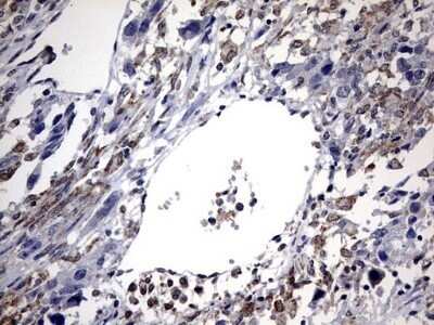 Immunohistochemistry: ABCD1 Antibody (OTI2C12) - Azide and BSA Free [NBP2-70150] - Analysis of Adenocarcinoma of Human ovary tissue. (Heat-induced epitope retrieval by 10mM citric buffer, pH6.0, 120C for 3min)