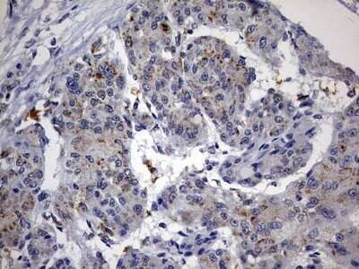 Immunohistochemistry: ABCD1 Antibody (OTI2C12) - Azide and BSA Free [NBP2-70150] - Analysis of Carcinoma of Human liver tissue.(Heat-induced epitope retrieval by 10mM citric buffer, pH6.0, 120C for 3min)