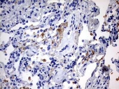 Immunohistochemistry: ABCD1 Antibody (OTI2C12) - Azide and BSA Free [NBP2-70150] - Analysis of Carcinoma of Human lung tissue.(Heat-induced epitope retrieval by 10mM citric buffer, pH6.0, 120C for 3min)