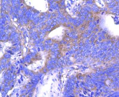 Immunohistochemistry-Paraffin: ABCF1 Antibody (SN07-12) [NBP2-67698] - Analysis of paraffin-embedded human colon cancer tissue using anti-ABCF1 antibody. Counter stained with hematoxylin.