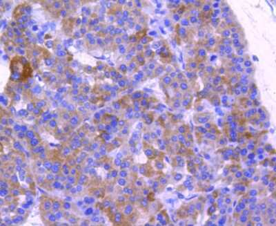 Immunohistochemistry-Paraffin: ABCF1 Antibody (SN07-12) [NBP2-67698] - Analysis of paraffin-embedded human liver cancer tissue using anti-ABCF1 antibody. Counter stained with hematoxylin.