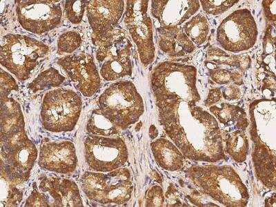 Immunohistochemistry-Paraffin: ABCF2 Antibody [NBP2-98976] - Immunochemical staining of human ABCF2 in human prostatic carcinoma with rabbit polyclonal antibody (1:1000, formalin-fixed paraffin embedded sections).