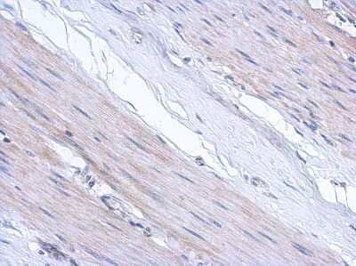 Immunohistochemistry-Paraffin: ABCF3 Antibody [NBP2-15227] - Paraffin-embedded colon ca, using antibody at 1:500 dilution.