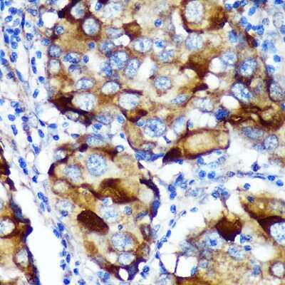 Immunohistochemistry-Paraffin: ABCF3 Antibody [NBP2-92211] - Immunohistochemistry of paraffin-embedded Human breast cancer using ABCF3 Rabbit pAb (NBP2-92211) at dilution of 1:100 (40x lens). Perform microwave antigen retrieval with 10 mM PBS buffer pH 7.2 before commencing with IHC staining protocol.