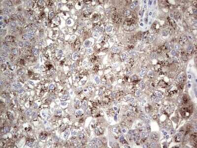 Immunohistochemistry: ABH1 Antibody (OTI4C4) - Azide and BSA Free [NBP2-71390] - Analysis of Carcinoma of Human lung tissue.(Heat-induced epitope retrieval by 1 mM EDTA in 10mM Tris, pH8.5, 120C for 3min)