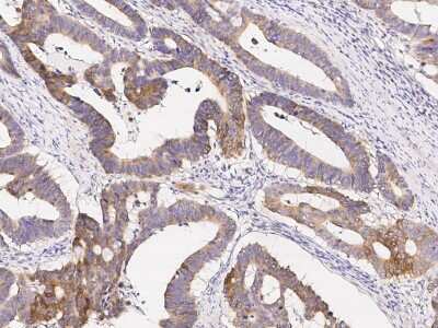 Immunohistochemistry-Paraffin: ABHD1 Antibody [NBP2-99171] - Immunochemical staining of human ABHD1 in human colon carcinoma with rabbit polyclonal antibody (1:1000, formalin-fixed paraffin embedded sections).