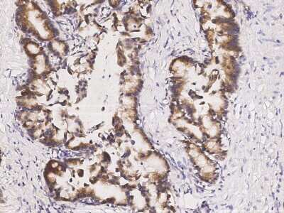 Immunohistochemistry-Paraffin: ABHD1 Antibody [NBP2-99171] - Immunochemical staining of human ABHD1 in human gastric cancer with rabbit polyclonal antibody (1:1000, formalin-fixed paraffin embedded sections).
