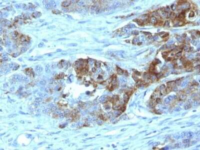 Immunohistochemistry-Paraffin: ABO, Blood Group H Antigen Antibody (19-OLE) - Azide and BSA Free [NBP2-47867] - Human Colon Carcinoma stained with Blood Group Antigen H Type 2 Monoclonal Antibody (19-OLE)