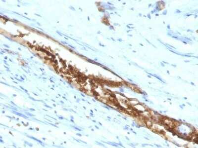 Immunohistochemistry-Paraffin: ABO, Blood Group A Antigen Antibody (3-3A) - IHC-Prediluted [NBP2-48069] - Human Colon Carcinoma stained with Blood Group Antigen A Monoclonal Antibody (3-3A)