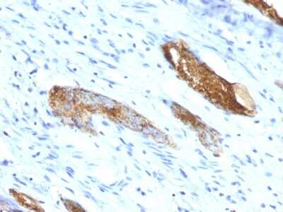 Immunohistochemistry-Paraffin: ABO, Blood Group A Antigen Antibody (33C13) [NBP2-44627] - Human Colon Carcinoma stained with Blood Group Antigen A Monoclonal Antibody (33C13)
