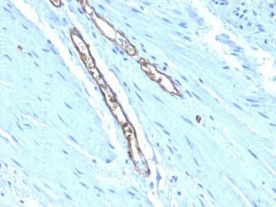 Immunohistochemistry-Paraffin: ABO, Blood Group A Antigen Antibody (HE-193) - Azide and BSA Free [NBP2-47869] - Human Colon Carcinoma stained with Blood Group Antigen A Monoclonal Antibody (HE-193)