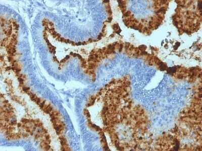 Immunohistochemistry-Paraffin: ABO, Blood Group A Antigen Antibody (HEB-20) - Azide and BSA Free [NBP2-47870] - Human Colon Carcinoma stained with Blood Group B Monoclonal Antibody (HEB-20).