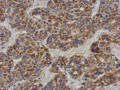 Immunohistochemistry-Paraffin: ACADL Antibody [NBP2-15235] - Paraffin-embedded Hepatoma, using antibody at 1:500 dilution.