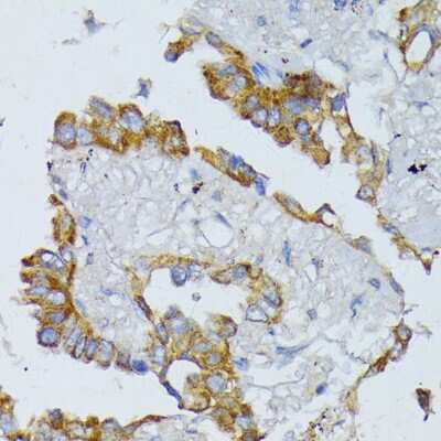 Immunohistochemistry-Paraffin: ACADL Antibody [NBP2-92854] - Human lung cancer using ACADL antibody at dilution of 1:100 (40x lens).