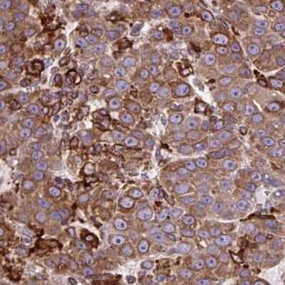 Immunohistochemistry: ACAT Antibody [NBP2-32052] - Staining of liver cancer.