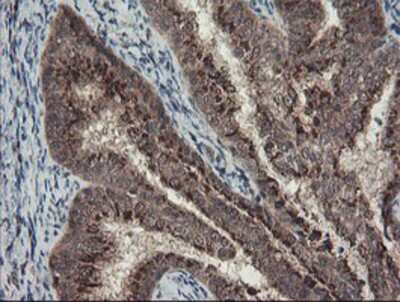 Immunohistochemistry-Paraffin: ACBD3 Antibody (3A1) [NBP2-03720] - Staining of paraffin-embedded Adenocarcinoma of Human endometrium tissue using anti-ACBD3 mouse monoclonal antibody.