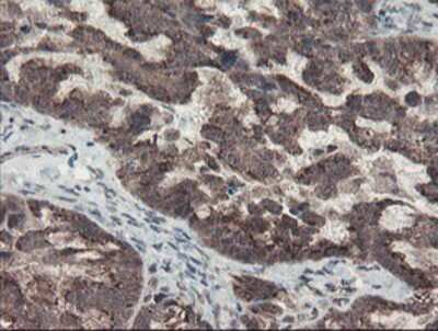 Immunohistochemistry-Paraffin: ACBD3 Antibody (3A1) [NBP2-03720] - Staining of paraffin-embedded Adenocarcinoma of Human ovary tissue using anti-ACBD3 mouse monoclonal antibody.