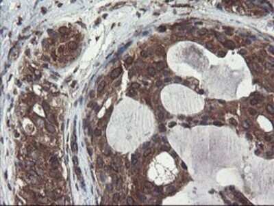 Immunohistochemistry: ACBD3 Antibody (OTI1G2) - Azide and BSA Free [NBP2-72148] - Analysis of Adenocarcinoma of Human breast tissue.