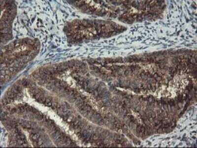 Immunohistochemistry: ACBD3 Antibody (OTI1G2) - Azide and BSA Free [NBP2-72148] - Analysis of Adenocarcinoma of Human endometrium tissue.