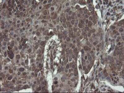 Immunohistochemistry: ACBD3 Antibody (OTI1G2) - Azide and BSA Free [NBP2-72148] - Analysis of Carcinoma of Human lung tissue.