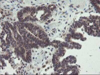 Immunohistochemistry: ACBD3 Antibody (OTI3A1) - Azide and BSA Free [NBP2-72149] - Staining of paraffin-embedded Adenocarcinoma of Human colon tissue using anti-ACBD3 mouse monoclonal antibody.