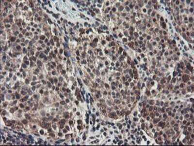Immunohistochemistry: ACBD3 Antibody (OTI3A1) - Azide and BSA Free [NBP2-72149] - Staining of paraffin-embedded Carcinoma of Human bladder tissue using anti-ACBD3 mouse monoclonal antibody.