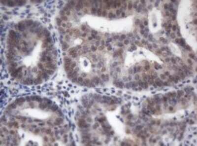 Immunohistochemistry: ACD Antibody (OTI2B1) - Azide and BSA Free [NBP2-72169] - Analysis of Adenocarcinoma of Human endometrium tissue. (Heat-induced epitope retrieval by 10mM citric buffer, pH6.0, 120C for 3min)