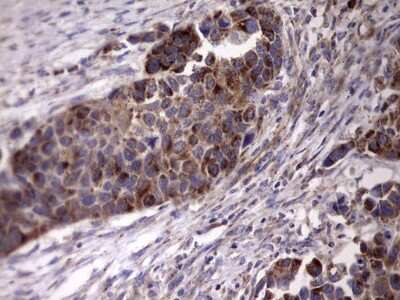 Immunohistochemistry: ACE-2 Antibody (OTI4D2) [NBP2-46490] - Analysis of Carcinoma of Human kidney tissue. (Heat-induced epitope retrieval by 1 mM EDTA in 10mM Tris, pH8.5, 120C for 3min)