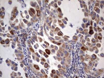 Immunohistochemistry: ACE-2 Antibody (OTI4D2) [NBP2-46490] - Analysis of Carcinoma of Human lung tissue.(Heat-induced epitope retrieval by 1 mM EDTA in 10mM Tris, pH8.5, 120C for 3min)