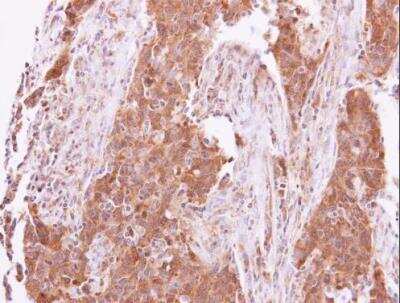 Immunohistochemistry-Paraffin: ACK1 Antibody [NBP1-32311] - Human lung papillory adenocarcinoma.  ACK1 antibody [N1N2], N-term dilution: 1:500.Antigen Retrieval: Trilogy™ (EDTA based, pH 8.0) buffer, 15min. 