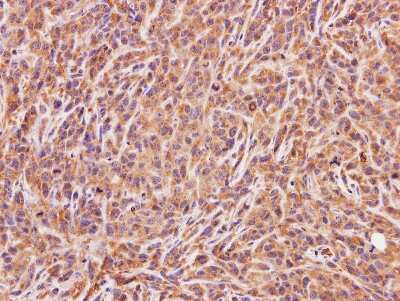 Immunohistochemistry-Paraffin: ACMSD Antibody [NBP1-33499] - SAS xenograft, using ACMSD antibody at 1:100 dilution. Antigen Retrieval: Trilogy™ (EDTA based, pH 8.0) buffer, 15min. 