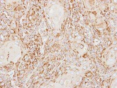 Immunohistochemistry-Paraffin: ACP2 Antibody [NBP2-15250] - ACP2 antibody [N2C3] detects ACP2 protein at lysosome on Ca922 xenograft by immunohistochemical analysis.  Sample: Paraffin-embedded Ca922 xenograft.  ACP2 antibody [N2C3] dilution: 1:500.