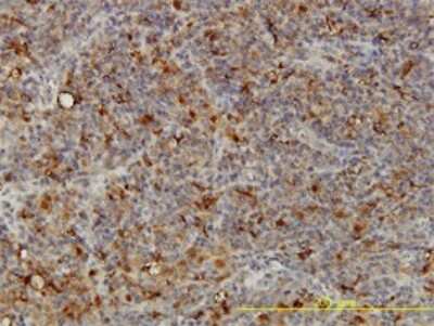 Immunohistochemistry-Paraffin: ACP2 Antibody (M1-4A12) [H00000053-M01] - Analysis of monoclonal antibody to ACP2 on formalin-fixed paraffin-embedded human lymphoma tissue. Antibody concentration 5 ug/ml.