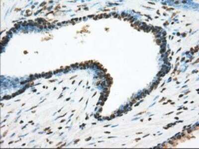 Immunohistochemistry: ACSBG1 Antibody (OTI1D8) - Azide and BSA Free [NBP2-71731] - Staining of paraffin-embedded Carcinoma of prostate tissue using anti-ACSBG1 mouse monoclonal antibody.