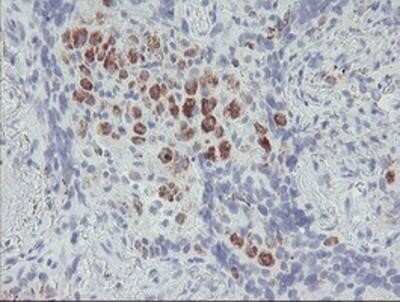 Immunohistochemistry: ACSF2 Antibody (OTI6E4) - Azide and BSA Free [NBP2-72220] - Staining of paraffin-embedded Carcinoma of Human lung tissue using anti-ACSF2 mouse monoclonal antibody.