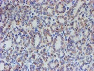 Immunohistochemistry: ACSF2 Antibody (OTI6E4) - Azide and BSA Free [NBP2-72220] - Staining of paraffin-embedded Carcinoma of Human thyroid tissue using anti-ACSF2 mouse monoclonal antibody.