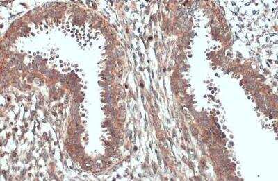Immunohistochemistry-Paraffin: ACSL3 Antibody [NBP2-15252] - Human breast carcinoma. ACSL3 stained by ACSL3 antibody diluted at 1:500.Antigen Retrieval: Citrate buffer, pH 6.0, 15 min. 